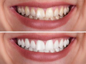 ماندگاری بلیچینگ دندان چقدر است؟