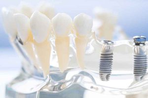 سوالات متداول در مورد قیمت ایمپلنت دندان
