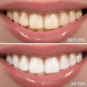 10 راه از بین بردن لکه‌ی دندان + 10 راه‌های جلوگیری لکه‌ی دندان-بهترین دندانپزشک تهران
