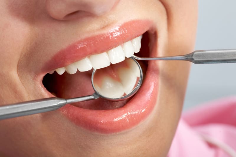 11 نکته مهم که ای کاش قبل از کامپوزیت دندان می‌دانستم - دکتر بنائیان