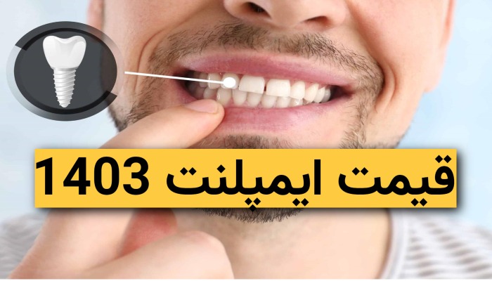 قیمت ایمپلنت دندان 1403 (اقساط با شرایط ویژه)