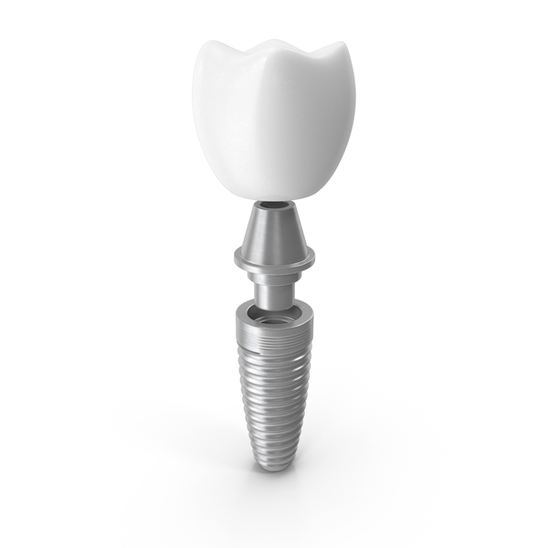 ایمپلنت دندان چیست ؟