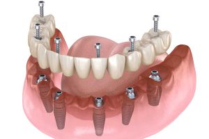 ایمپلنت فک بالا و فک پایین | بهترین جراح دندانپزشک با شرایط اقساط