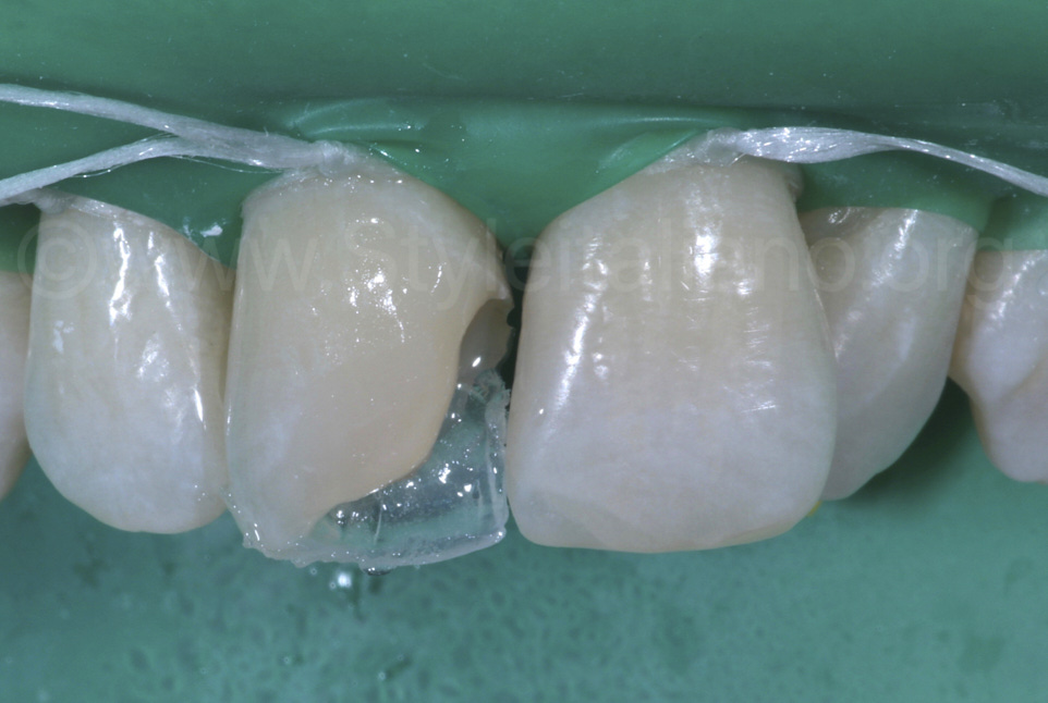 ترمیم کامپوزیت دندان: مراحل، دلایل، و راه‌های پیشگیری