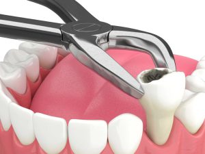زمان مناسب کاشت دندان بعد از کشیدن دندان