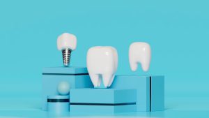 آیا می‌توان ایمپلنت دندان را سفید کرد ؟