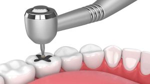 4 مورد مهم از عوارض پر كردن دندان