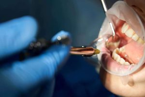عوارض بی حسی دندان چیست؟