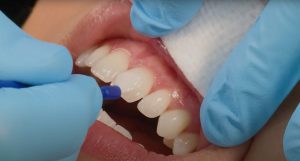 پالیش کامپوزیت دندان چگونه انجام می‌شود؟