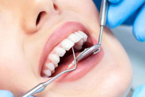 علت تغییر رنگ کامپوزیت دندان چیست؟