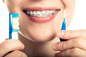 راه‌های مراقبت از انواع ارتودنسی دندان