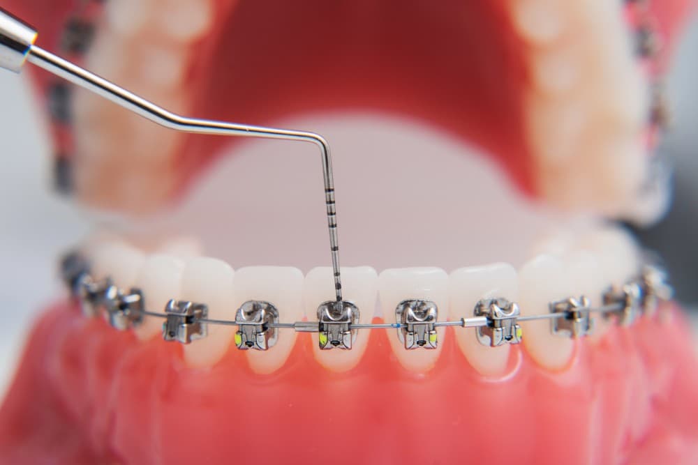 انواع ارتودنسی دندان چیست و کدام یک برای شما مناسب است؟