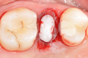 پانسمان دندان چیست ؟ کابرد و مراقب‌های بعد از آن