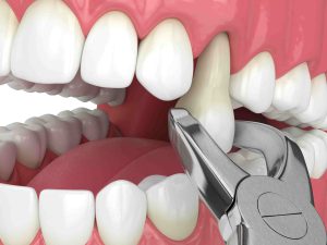 راه‌های مراقبت بعد از کشیدن دندان