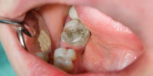 روش‌های پیشگیری از دندان نکروز