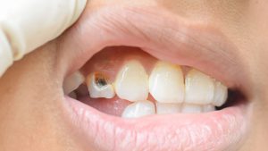 پرسش‌های پرتکرار در مورد دندان نکروز شده یا مرده: