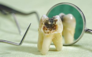 دندان مرده یا نکروز شده : علائم و روش درمانی