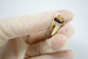 درمان دندان مرده یا نکروز شده