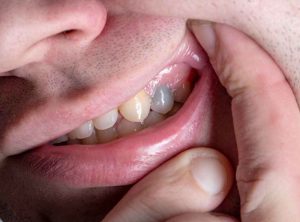 علائم نکروز شدن دندان