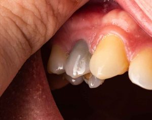 عوارض نکروز پالپ دندانی چیست؟