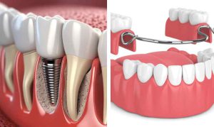 مقایسه ایمپلنت دندان و دندان مصنوعی تکی