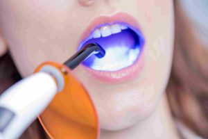 مراحل کامپوزیت دندان : مدت زمان + نکات مهم
