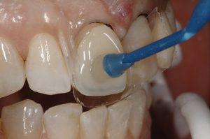 سوالات پرتکرار درباره کامپوزیت دندان