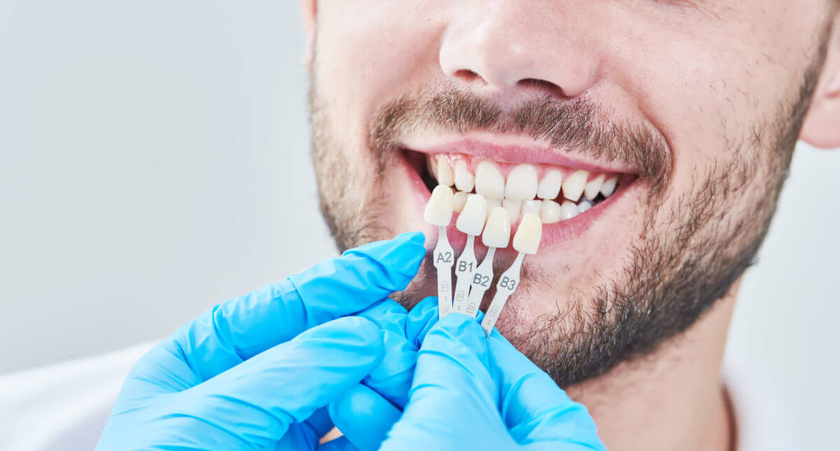 مزایا و معایب روکش ایمکس دندان: کامپوزیت و لمینت