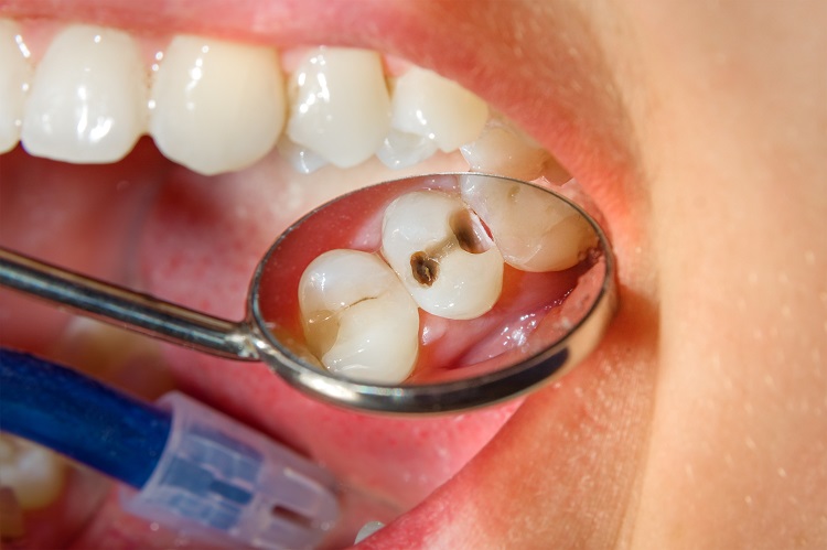 شایع‌ترین بیماری بشر مربوط به دندان است